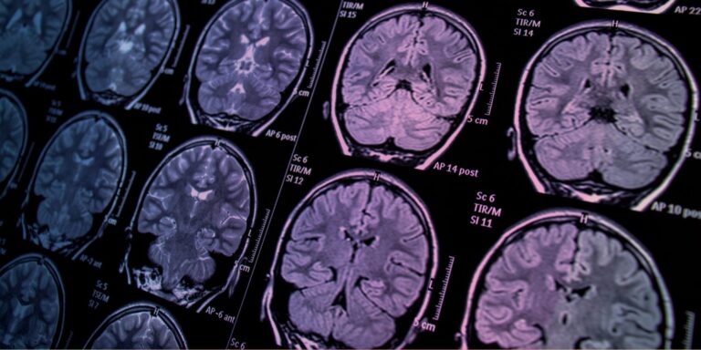 Alterations of regional brain activity and corresponding brain circuits in drug-naïve adolescents with nonsuicidal self-injury